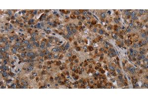 Immunohistochemistry of paraffin-embedded Human liver cancer using MAP3K11 Polyclonal Antibody at dilution of 1:40
