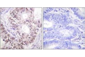 Immunohistochemistry analysis of paraffin-embedded human colon carcinoma, using CDC25C (Phospho-Thr48) Antibody.