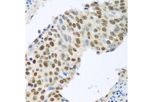 Immunohistochemistry of paraffin-embedded human lung cancer using MDC1 antibody at dilution of 1:100 (40x lens).
