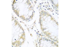 Immunohistochemistry of paraffin-embedded human gastric cancer using CUL3 antibody (ABIN5970436) at dilution of 1/100 (40x lens). (Cullin 3 antibody)