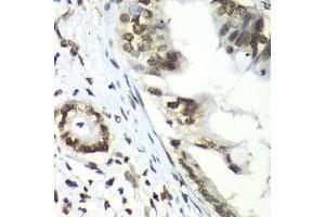 Immunohistochemistry of paraffin-embedded human liver cancer using TEAD1 antibody at dilution of 1:100 (x40 lens). (TEAD1 antibody)