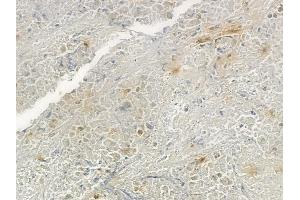 ABIN6266259 and ABIN6277418 at 1/100 staining human lung squamous cell carcinoma by IHC-P. (P2RY4 antibody  (C-Term))
