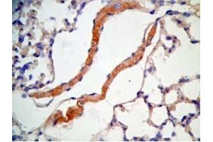 Mouse lung cancer tissue stained by Rabbit Anti-CRAMP  Antibody (Cathelicidin antibody  (AA 140-173))
