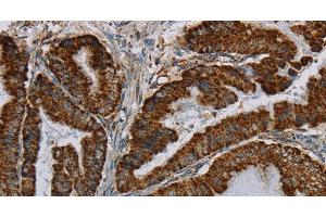 Immunohistochemistry of paraffin-embedded Human esophagus cancer using HSD17B2 Polyclonal Antibody at dilution of 1:50 (HSD17B2 antibody)