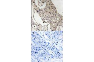 Immunohistochemical staining of human breast carcinoma tissue by GAB2 (phospho S623) polyclonal antibody  without blocking peptide (A) or preincubated with blocking peptide (B) under 1:50-1:100 dilution. (GAB2 antibody  (pSer623))