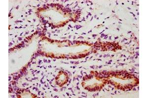 IHC image of ABIN7127700 diluted at 1:100 and staining in paraffin-embedded human breast cancer performed on a Leica BondTM system.