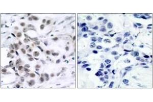 Immunohistochemistry analysis of paraffin-embedded human breast carcinoma tissue, using Chk1 (Ab-317) Antibody. (CHEK1 antibody  (AA 286-335))