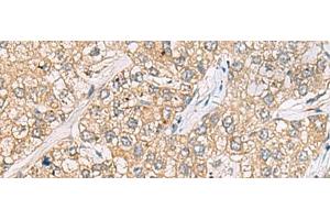 Immunohistochemistry of paraffin-embedded Human liver cancer tissue using P3H2 Polyclonal Antibody at dilution of 1:30(x200) (LEPREL1 antibody)