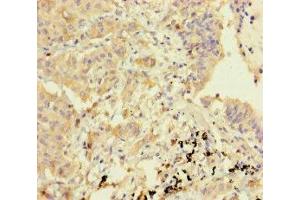 Immunohistochemistry of paraffin-embedded human lung cancer using ABIN7154785 at dilution of 1:100 (GBP6 antibody  (AA 401-600))