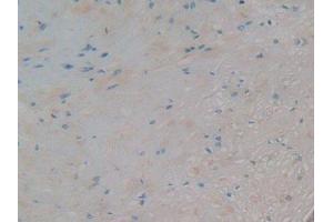 IHC-P analysis of Human Prostate Cancer Tissue, with DAB staining.
