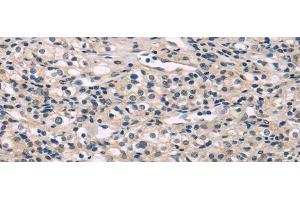 Immunohistochemistry of paraffin-embedded Human prostate cancer using MED28 Polyclonal Antibody at dilution of 1/30 (MED28 antibody)