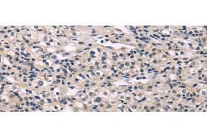 Immunohistochemistry of paraffin-embedded Human prostate cancer using MED28 Polyclonal Antibody at dilution of 1/30 (MED28 antibody)
