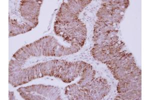 IHC-P Image Immunohistochemical analysis of paraffin-embedded human colon carcinoma, using OTC, antibody at 1:250 dilution. (OTC antibody)