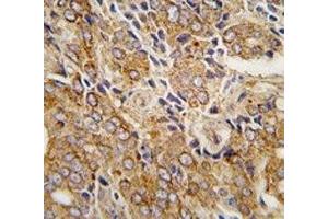 IHC analysis of FFPE human prostate carcinoma tissue stained with TRPM8 antibody (TRPM8 antibody  (AA 926-956))