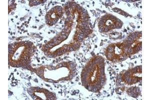 IHC-P Image Immunohistochemical analysis of paraffin-embedded human colon carcinoma, using TIE1, antibody at 1:500 dilution. (TIE1 antibody)