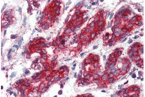 Human Breast (formalin-fixed, paraffin-embedded) stained with SOD2 antibody ABIN396955 at 1:50 followed by biotinylated anti-mouse IgG secondary antibody ABIN481714, alkaline phosphatase-streptavidin and chromogen. (SOD2 antibody)