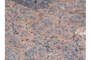 Detection of b2M in Human Liver cancer Tissue using Polyclonal Antibody to Beta-2-Microglobulin (b2M) (beta-2 Microglobulin antibody  (AA 22-119))