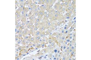 Immunohistochemistry of paraffin-embedded human liver cancer using PPBP antibody at dilution of 1:100 (40x lens).