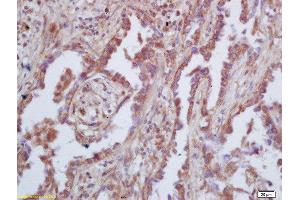 Formalin-fixed and paraffin embedded human lung carcinoma  labeled with Rabbit Anti-GAS 6 Polyclonal Antibody, Unconjugated (ABIN873146) at 1:200 followed by conjugation to the secondary antibody and DAB staining (GAS6 antibody  (AA 551-650))