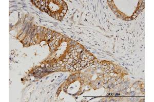 Immunoperoxidase of monoclonal antibody to SERBP1 on formalin-fixed paraffin-embedded human pancreatic cancer. (SERBP1 antibody  (AA 1-402))