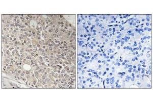 Immunohistochemistry analysis of paraffin-embedded human prostate carcinoma tissue using AMOTL1 antibody. (AMOTL1 antibody  (Internal Region))