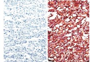 Paraffin embedded AIDS-associated Burkitt lymphoma tissue array was stained with anti-CXCR5 (right) and Rat IgG2b-UNLB