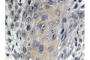 Immunohistochemical analysis of paraffin-embedded human cervix cancer tissue using COPZ1 polyclonal antibody . (COPZ1 antibody)