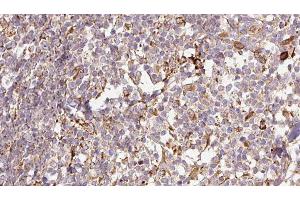 ABIN6276757 at 1/100 staining Human Melanoma tissue by IHC-P. (MMP13 antibody  (N-Term))