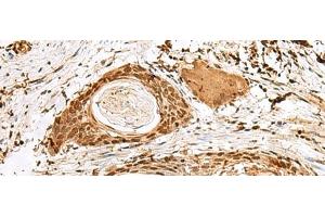 Immunohistochemistry of paraffin-embedded Human esophagus cancer tissue using SNAPC1 Polyclonal Antibody at dilution of 1:40(x200) (SNAPC1 antibody)