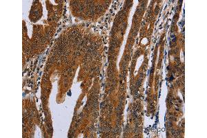 Immunohistochemistry of Human gastric cancer using GH2 Polyclonal Antibody at dilution of 1:60 (Growth Hormone 2 antibody)