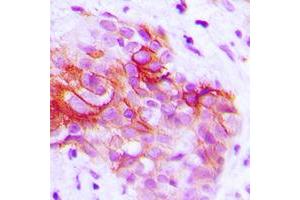 Immunohistochemical analysis of CD9 staining in human prostate cancer formalin fixed paraffin embedded tissue section. (CD9 antibody  (Center))