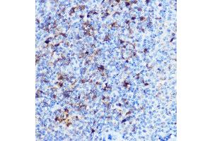 Immunohistochemistry of paraffin-embedded human liver cancer using NF-kB p65/RelA Rabbit pAb (ABIN6131885, ABIN6146861, ABIN6146863 and ABIN6215108) at dilution of 1:200 (40x lens). (NF-kB p65 antibody  (AA 1-200))