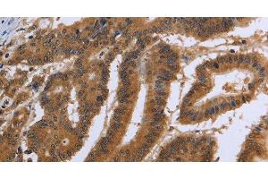 Immunohistochemistry of paraffin-embedded Human colon cancer using DUSP8 Polyclonal Antibody at dilution of 1:30
