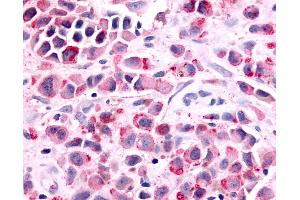 Anti-PTGER1 / EP1 antibody IHC of human Skin, Melanoma. (PTGER1 antibody  (Cytoplasmic Domain))