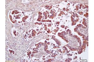 Formalin-fixed and paraffin embedded human lung carcinoma labeled with Anti-CD200/MOX1 Polyclonal Antibody, Unconjugated (ABIN761396) at 1:200 followed by conjugation to the secondary antibody and DAB staining