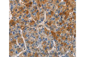 Immunohistochemistry of Human thyroid cancer using CST4 Polyclonal Antibody at dilution of 1:60 (CST4 antibody)