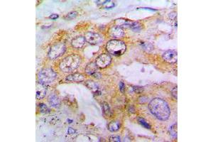 Immunohistochemical analysis of EIF4G1 (pS1148) staining in human lung cancer formalin fixed paraffin embedded tissue section. (EIF4G1 antibody  (pSer1148))