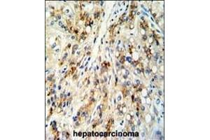 Formalin-fixed and paraffin-embedded human hepatocarcinoma reacted with CECR5 Antibody (Center), which was peroxidase-conjugated to the secondary antibody, followed by DAB staining. (CECR5 antibody  (AA 164-190))