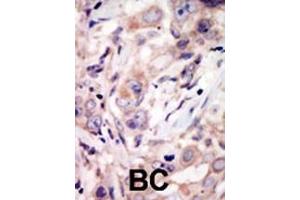 Formalin-fixed and paraffin-embedded human cancer tissue reacted with the primary antibody, which was peroxidase-conjugated to the secondary antibody, followed by DAB staining. (ROR2 antibody  (C-Term))