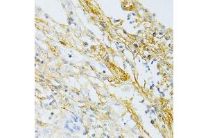 Immunohistochemistry of paraffin-embedded human lung cancer using TGFBI antibody. (TGFBI antibody  (AA 481-683))