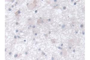 Detection of CCT2 in Human Glioma Tissue using Polyclonal Antibody to Chaperonin Containing TCP1, Subunit 2 (CCT2) (CCT2 antibody  (AA 1-488))