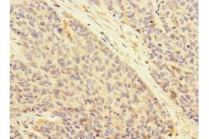 Immunohistochemistry of paraffin-embedded human ovarian cancer using ABIN7145065 at dilution of 1:100 (Attractin antibody  (AA 84-350))