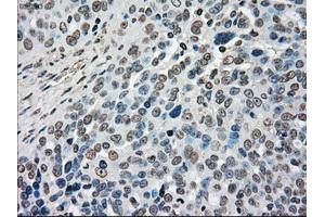 Immunohistochemical staining of paraffin-embedded Adenocarcinoma of ovary tissue using anti-MAP2K4mouse monoclonal antibody.