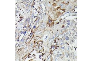 Immunohistochemistry of paraffin-embedded human esophageal cancer using PDGFRB Rabbit pAb (ABIN6134579, ABIN6145372 and ABIN7101437) at dilution of 1:100 (40x lens). (PDGFRB antibody)