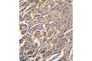 Formalin-fixed and paraffin-embedded human lung carcinoma tissue reacted with ALDH3A1 antibody (Center), which was peroxidase-conjugated to the secondary antibody, followed by DAB staining. (ALDH3A1 antibody  (AA 254-284))