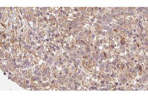 ABIN6279790 at 1/100 staining Human Melanoma tissue by IHC-P. (FRZB antibody  (C-Term))