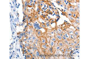 Immunohistochemistry of Human cervical cancer using CLDN1 Polyclonal Antibody at dilution of 1:150 (Claudin 1 antibody)