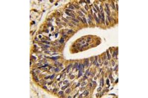 Formalin-fixed and paraffin-embedded human prostata carcinoma tissue reacted with Phospho-ErbB2-pY1248.