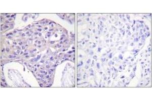 Immunohistochemistry analysis of paraffin-embedded human breast carcinoma tissue, using FOXO1/3/4-pan (Ab-24/32) Antibody. (FOXO1 antibody  (AA 15-64))
