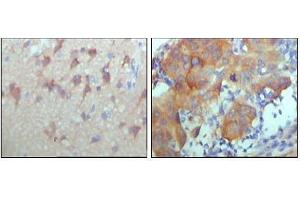 Immunohistochemical analysis of paraffin-embedded human cerebra (left) and breast carcinoma tissue (right),showing cytoplasmic and membrane location with DAB staining using ERBB3 antibody. (ERBB3 antibody  (AA 1175-1275))